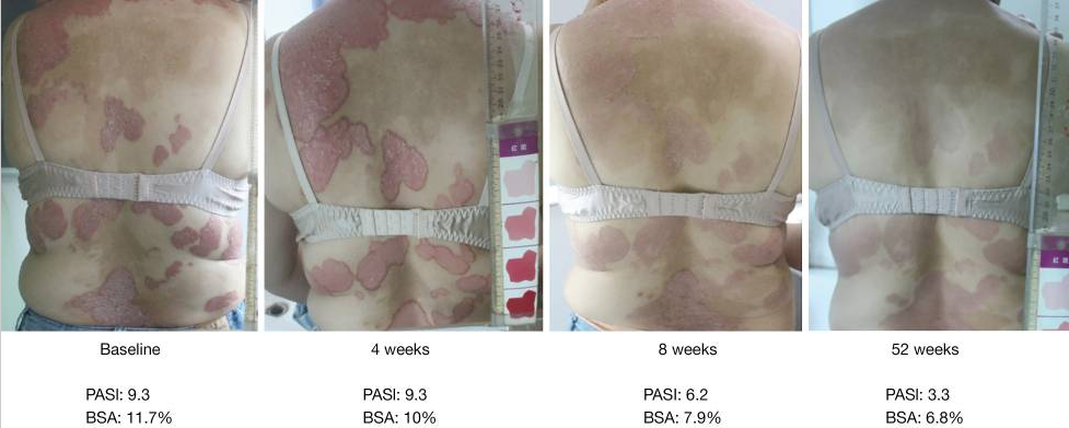 受試者治療前后的代表性皮膚圖像