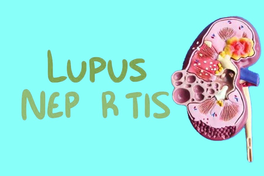干細(xì)胞治療狼瘡性腎炎:2019-2024年臨床研究進(jìn)展回顧 干細(xì)胞治療狼瘡性腎炎:2019-2024年臨床研究進(jìn)展回顧