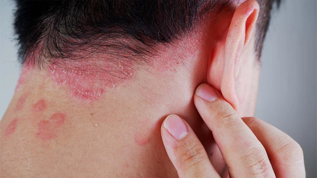 銀屑病如何治療？干細(xì)胞療法如何為銀屑病患者掃除障礙？