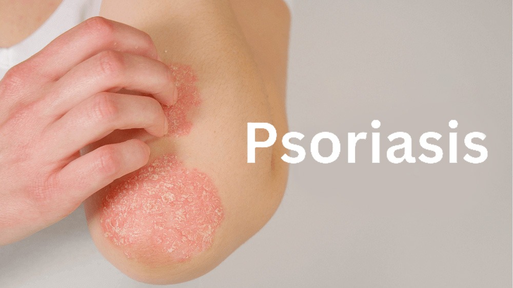 銀屑病治療新篇章：盤點2020-2024年干細胞治療銀屑病臨床研究進展