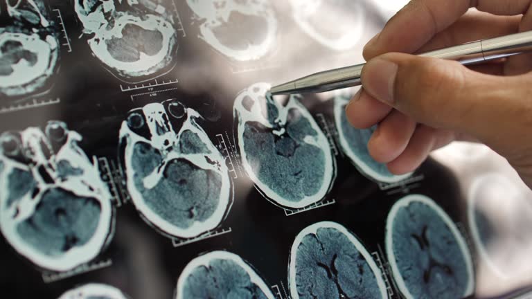 事關神經退行性疾病，干細胞在治療神經退行性疾病的療效、倫理、安全等問題的綜述