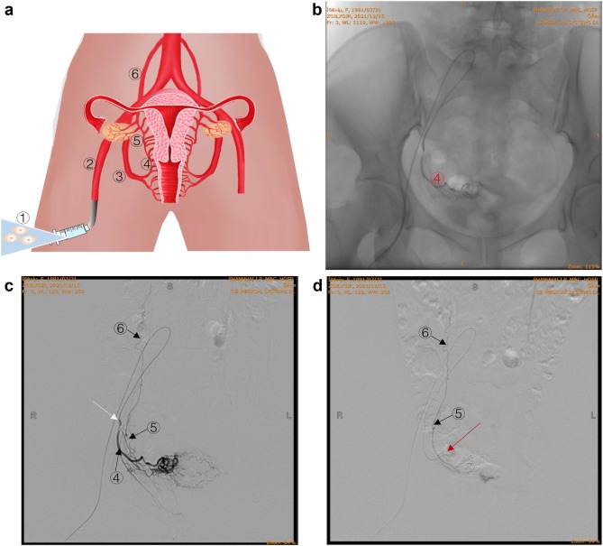 圖 2：通過卵巢?動(dòng)脈精確輸注 hAEC。