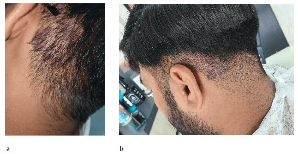 圖2：患者頸部枕部下方頭皮牛皮癬治療后圖像，治療后2周（a）和4周（b）隨訪時頭皮牛皮癬銀色鱗片和斑塊減少