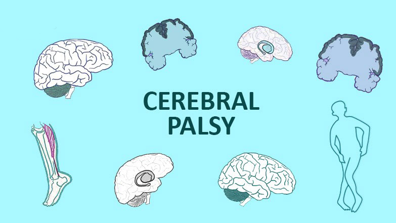 從步履蹣跚到穩健行走：干細胞技術如何重塑腦癱兒童平衡能力？