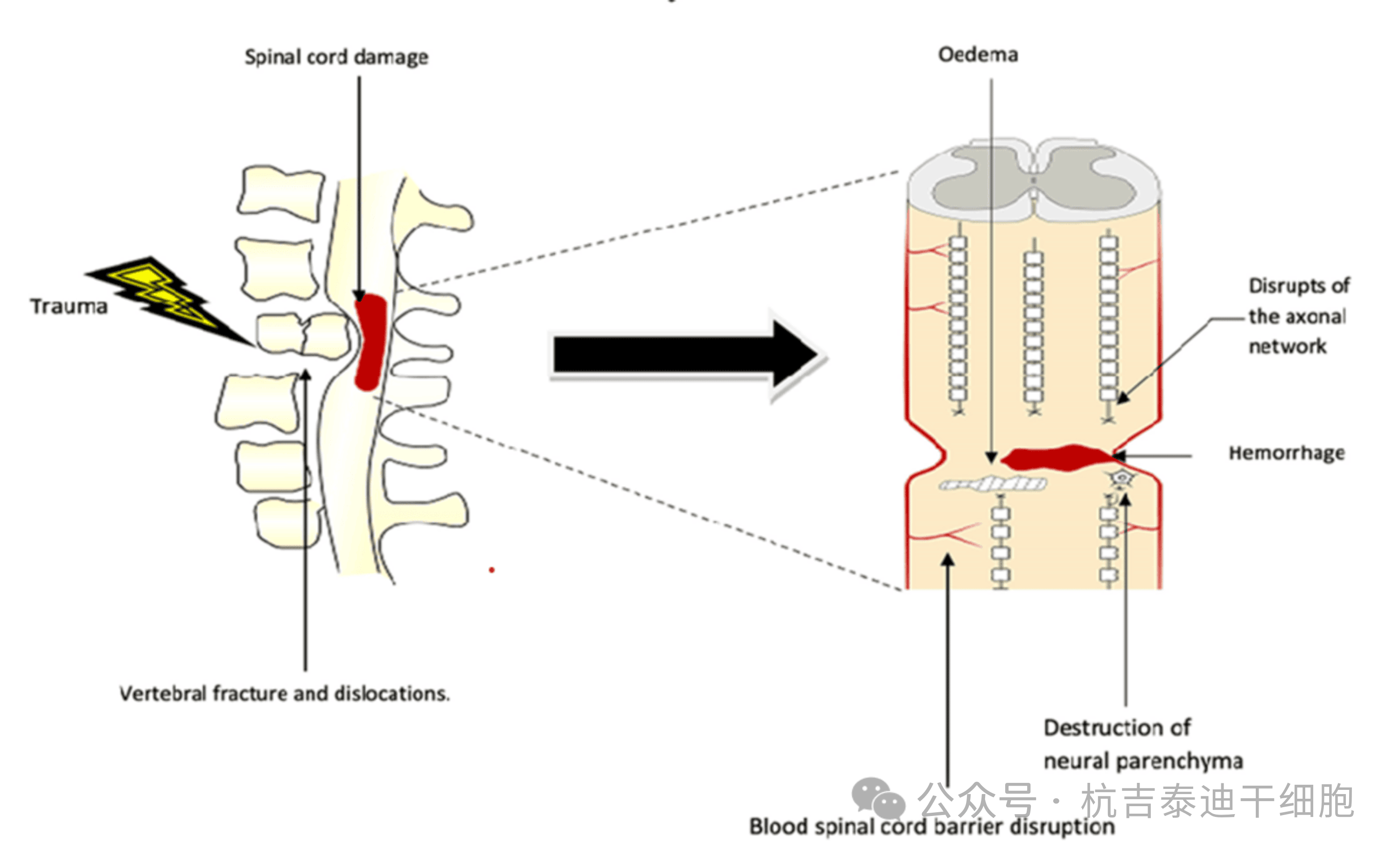 圖1：原發性病變，該圖顯示了創傷的直接影響，包括椎骨骨折、脫位和脊髓損傷導致軸突斷裂、水腫、出血和神經實質破壞