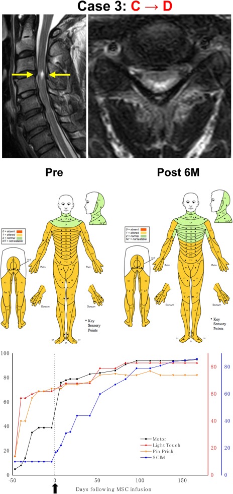干細胞治療后患者的恢復狀態圖 干細胞治療后患者的恢復狀態圖