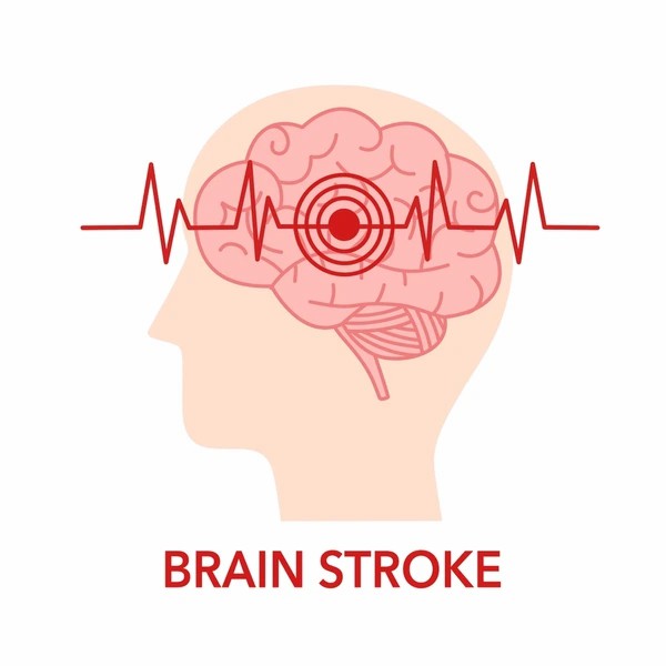 直擊腦卒中：神經(jīng)干細(xì)胞移植的治療方法有哪些？