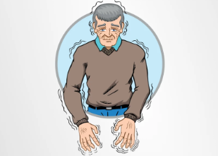 從短期緩解到長期穩定：干細胞移植治療帕金森病的療效持續時間研究