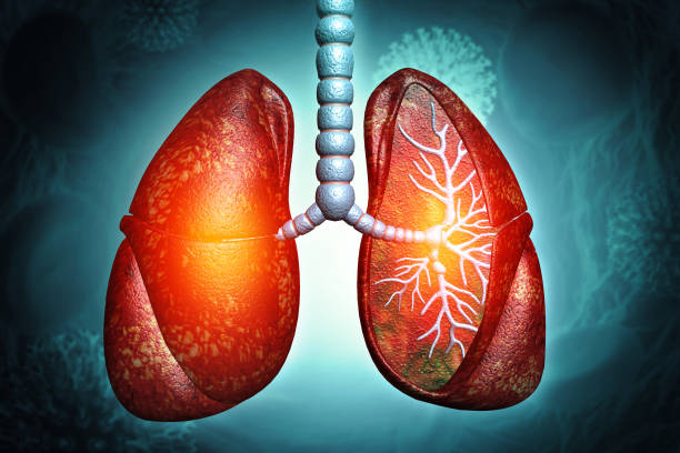 間充質干細胞治療4大類肺部疾病的臨床試驗進展及挑戰