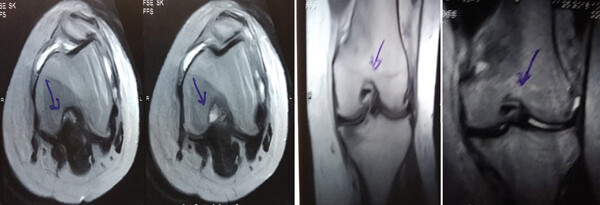 治療前 MRI 顯示內(nèi)側(cè)和外側(cè)半月板后角 III 級(jí)撕裂。