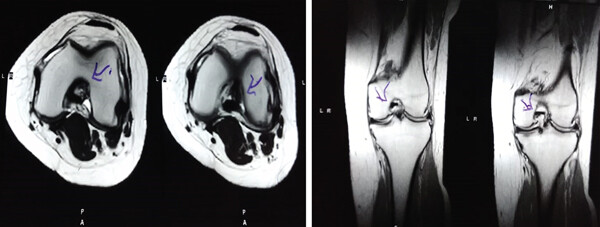 治療后MRI檢查顯示內(nèi)側(cè)和外側(cè)半月板后角撕裂有所改善