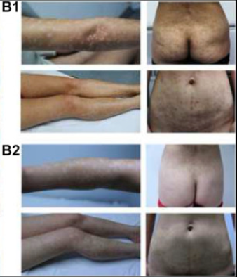 患者二治療前后對比圖 患者二治療前后對比圖