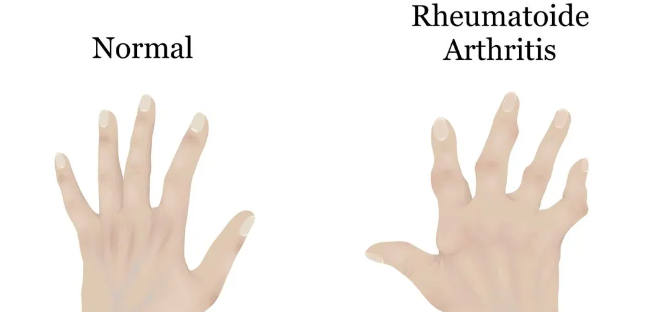 干細(xì)胞治療類風(fēng)濕關(guān)節(jié)炎：如何實(shí)現(xiàn)從短期關(guān)節(jié)功能改善到長(zhǎng)期的生活質(zhì)量提升？