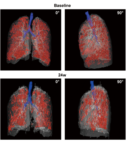 患者 #2902 自體 P63 細胞移植前和后 24 周連續(xù)肺部 CT 圖像的三維可視化。