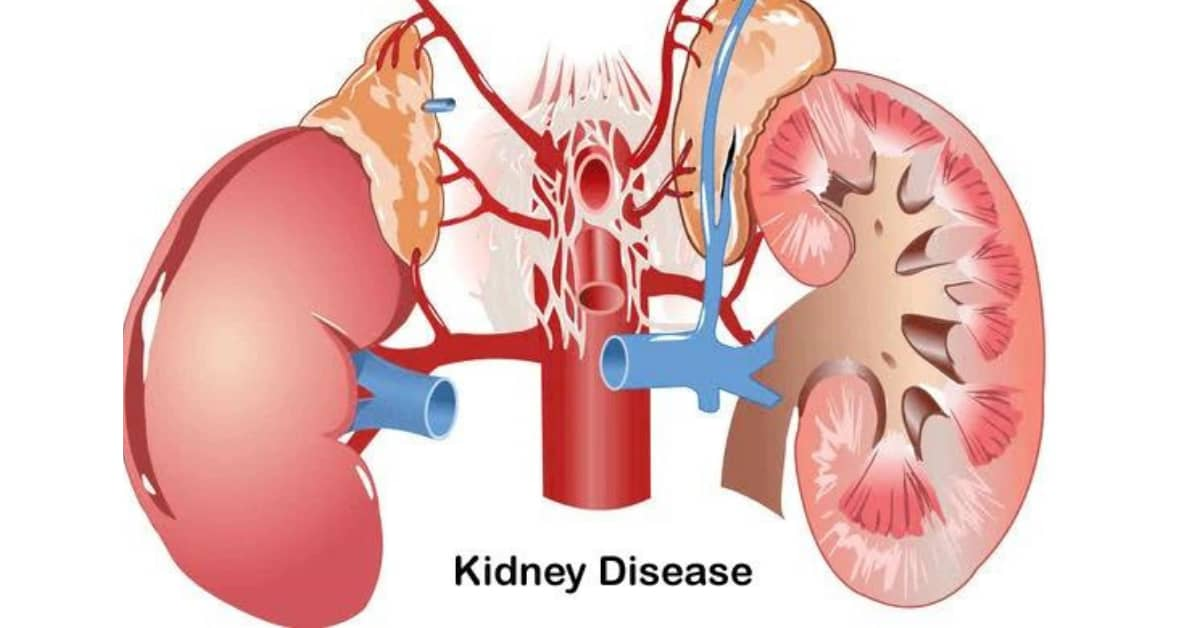 干細胞治療腎?。红o脈、動脈、皮質注射哪種更安全