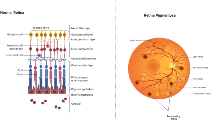 圖6：正常視網(wǎng)膜與受視網(wǎng)膜色素變性影響的視網(wǎng)膜的比較。