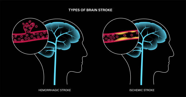 從癱瘓到復健!神經干細胞療法5大機制如何促進中風后的大腦修復? 從癱瘓到復健!神經干細胞療法5大機制如何促進中風后的大腦修復?