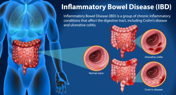 干細胞終結炎癥性腸??？8大問題解答揭秘細胞療法如何改寫治療規則
