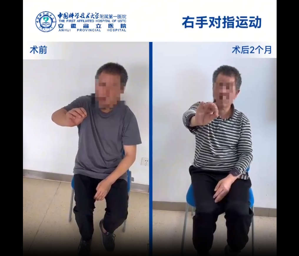 國內(nèi)誘導(dǎo)多能干細(xì)胞療法新突破：首例早發(fā)型帕金森病成功給藥，當(dāng)天即可行走