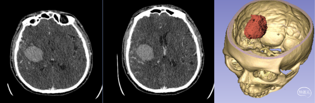神經(jīng)外科手術(shù)機(jī)器人輔助下腦內(nèi)血腫穿刺術(shù) 神經(jīng)外科手術(shù)機(jī)器人輔助下腦內(nèi)血腫穿刺術(shù)