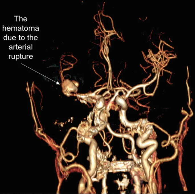 圖2：出血導(dǎo)致中風(fēng)