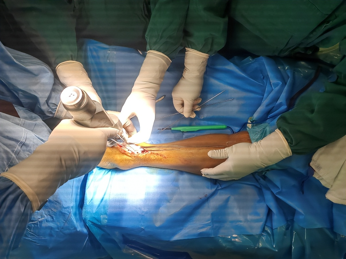 術(shù)中截骨導(dǎo)板輔助下精準(zhǔn)截骨并安放假體