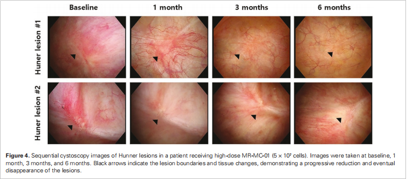 間質性膀胱炎臨床試驗