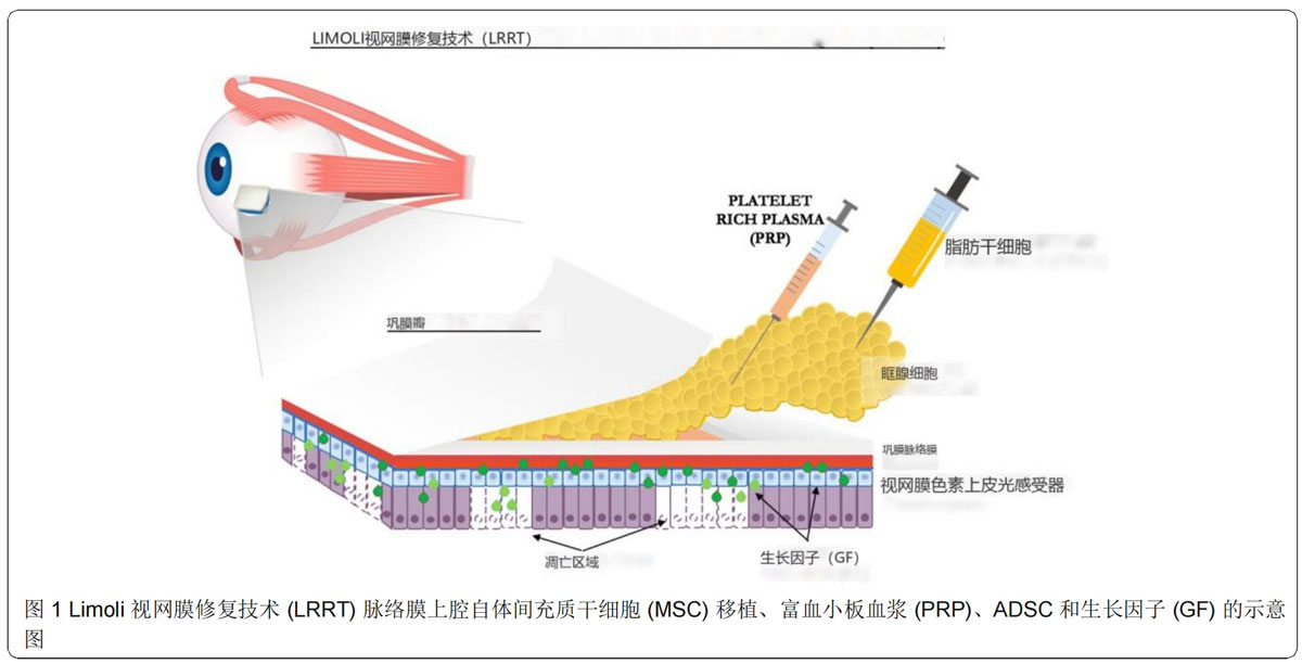 青光眼臨床試驗