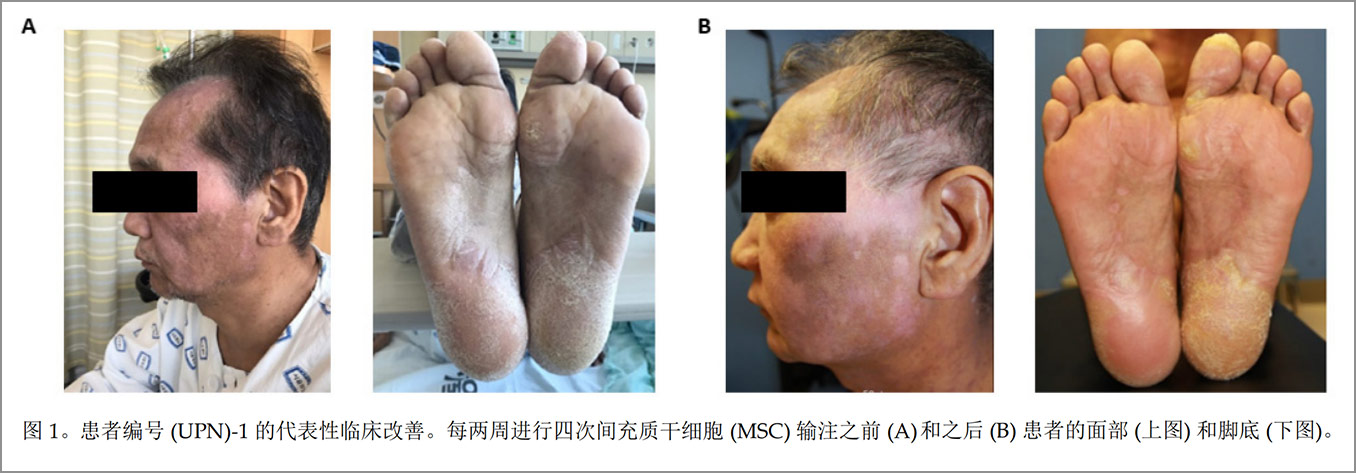 GVHD臨床試驗(yàn)