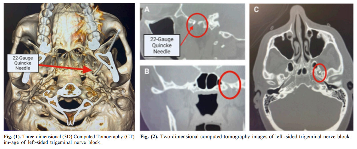 三叉神經痛臨床試驗 三叉神經痛臨床試驗