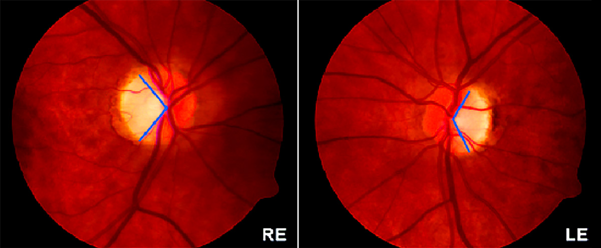 顯性視神經(jīng)萎縮