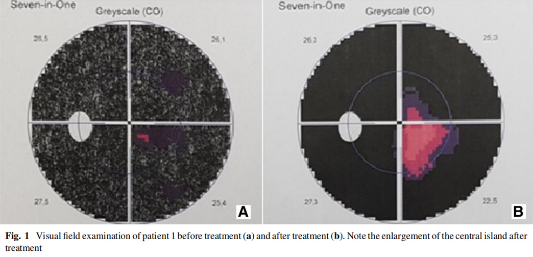 視神經(jīng)萎縮臨床試驗(yàn)