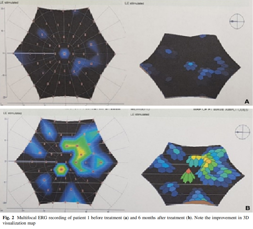 視神經(jīng)萎縮臨床試驗(yàn)