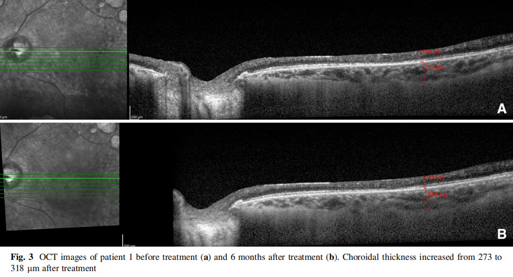 視神經(jīng)萎縮臨床試驗(yàn)