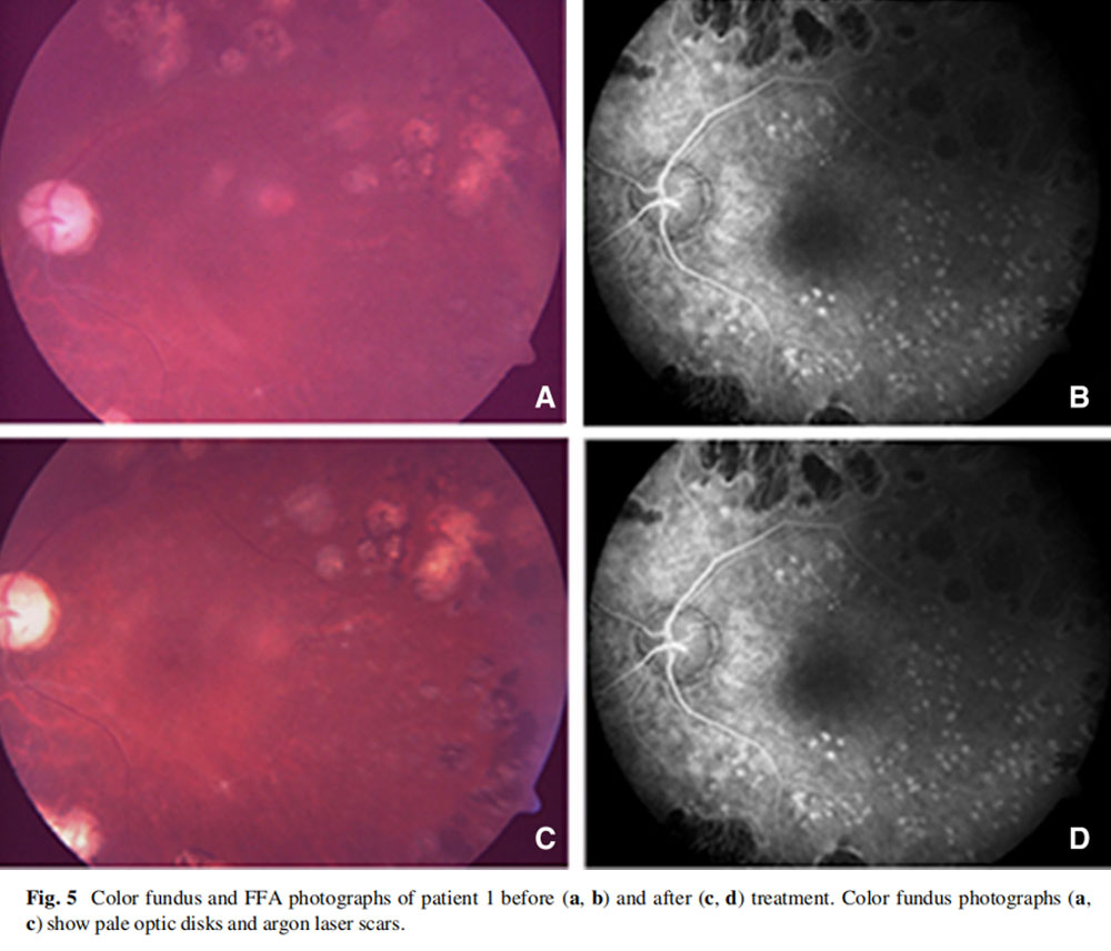 視神經(jīng)萎縮臨床試驗(yàn)