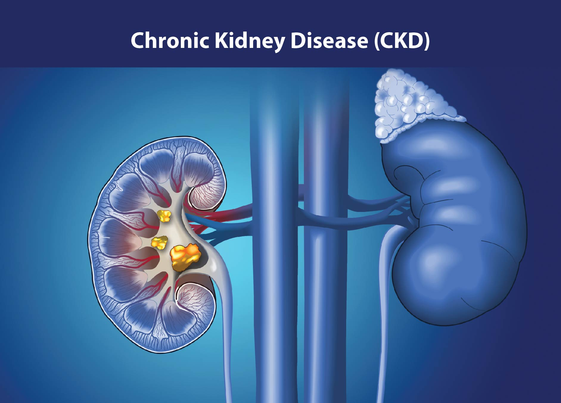 慢性腎病治療新策略：間充質干細胞如何修復腎功能、延緩疾病進展？