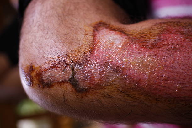 干細(xì)胞修復(fù)面部深度燒傷：1例患者術(shù)后面部基本恢復(fù)正常 | 成功案例