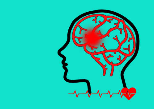 哪些中風患者適合干細胞治療？專家公布了5大評估標準