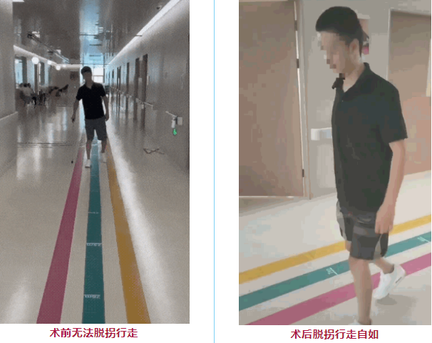 干細(xì)胞治療脊髓損傷患者