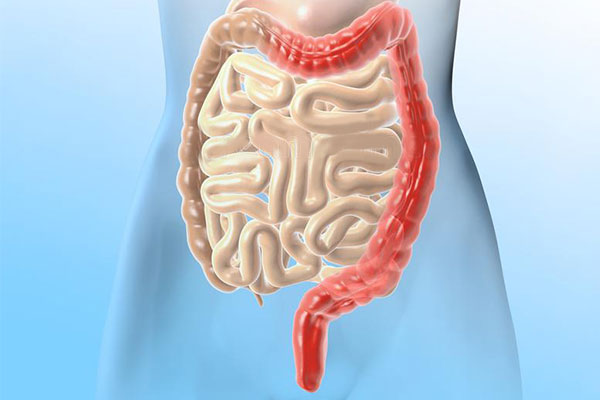 潰瘍性結腸炎新希望：干細胞移植2個月緩解率達7成，4成患者實現粘膜愈合