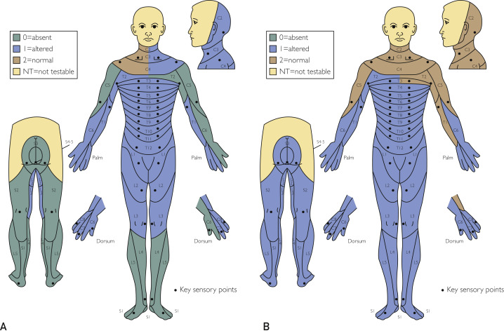 圖2：根據(jù)脊髓損傷神經(jīng)學(xué)分類國(guó)際標(biāo)準(zhǔn)，在基線（A）和 18 個(gè)月隨訪（B）時(shí)形成的皮節(jié)感覺(jué)評(píng)分。