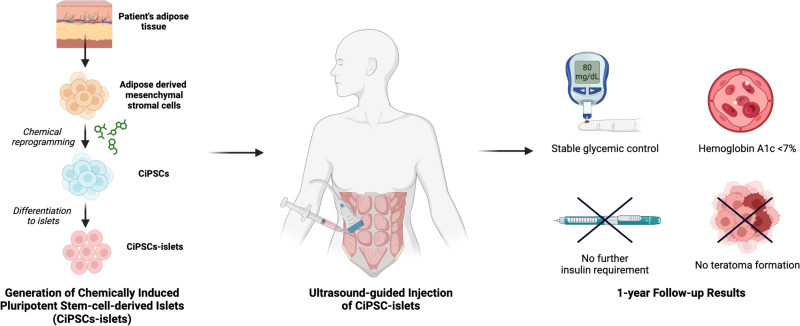 圖示：?通過將患者脂肪組織提取的間充質干細胞化學重編程為誘導多能干細胞并分化為胰島，再注射入腹直肌前鞘。