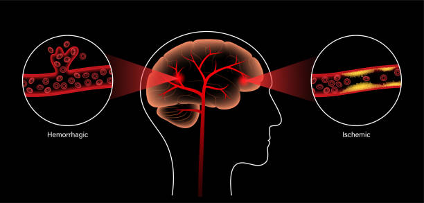 臍帶干細(xì)胞靜脈注射治療腦卒中？Ⅰ期人體研究結(jié)果公布：臨床顯示安全有效